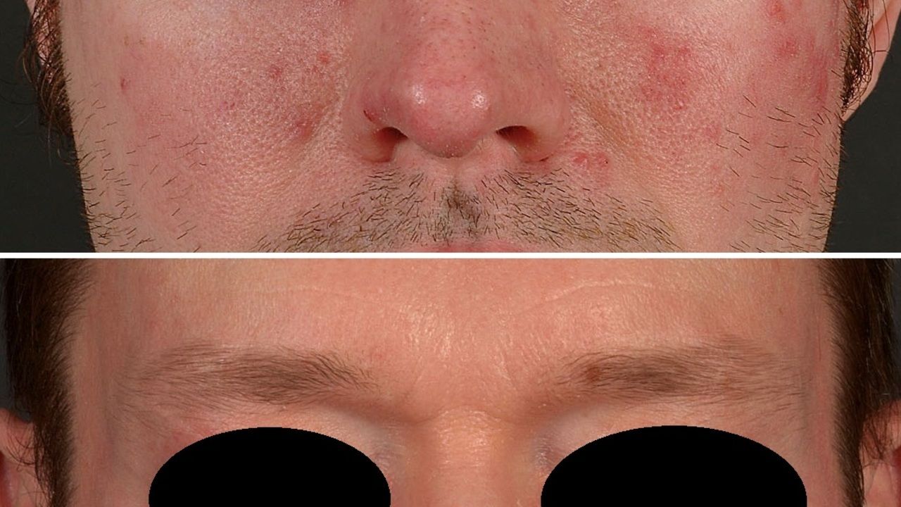 Preis für isotretinoin