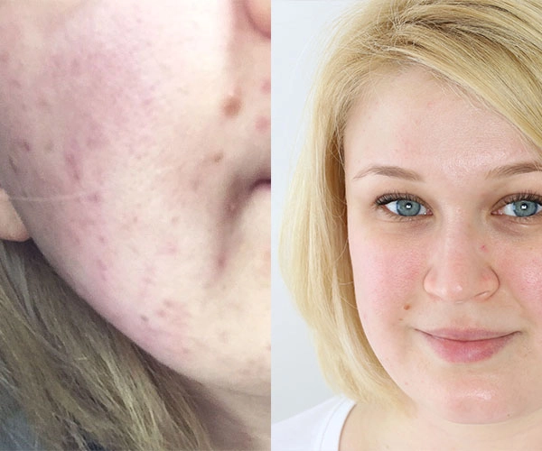 pille abgesetzt aknenormin