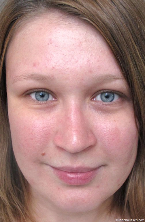 Accutane creme kaufen