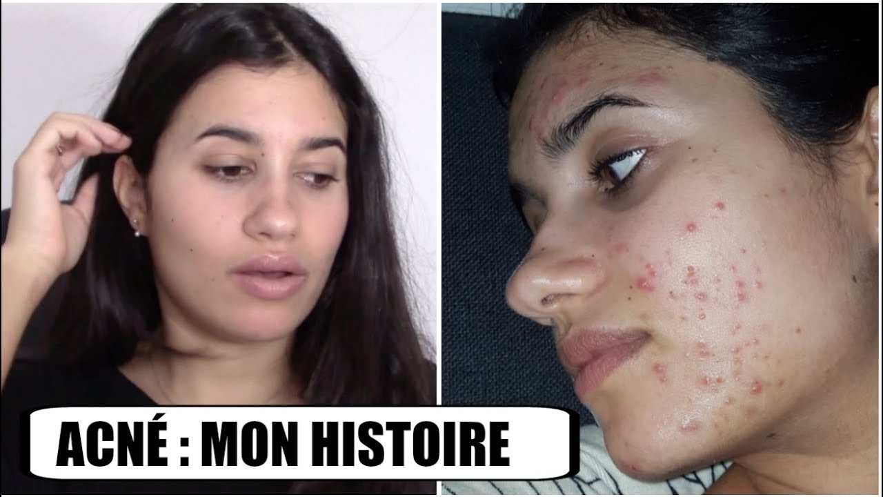 Roaccutane tablette