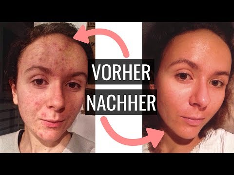 Aknenormin Nur Mit Pille