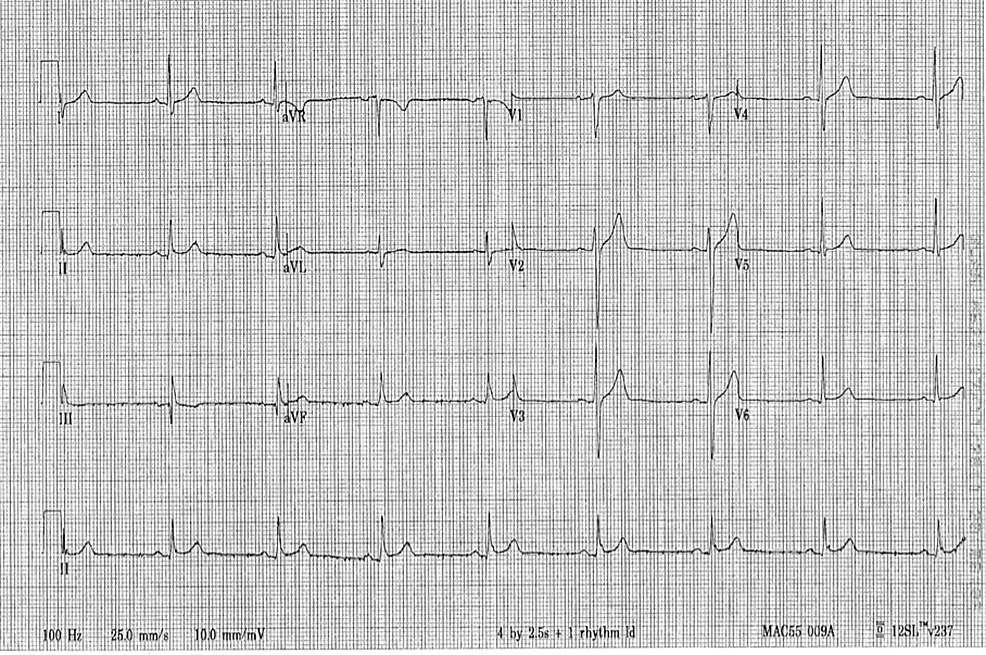 Propranolol Am Billigsten
