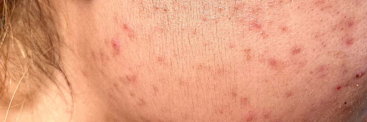 Roaccutan Bestellung