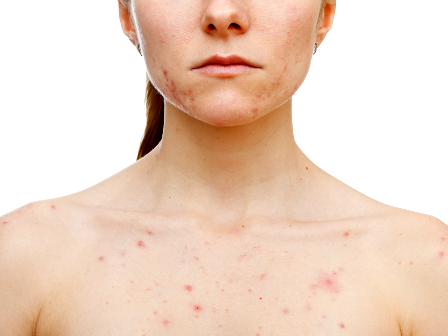 Pille abgesetzt isotretinoin