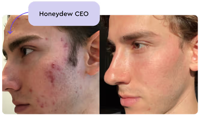 Accutane kosten