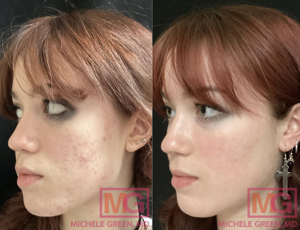 Generisches accutane