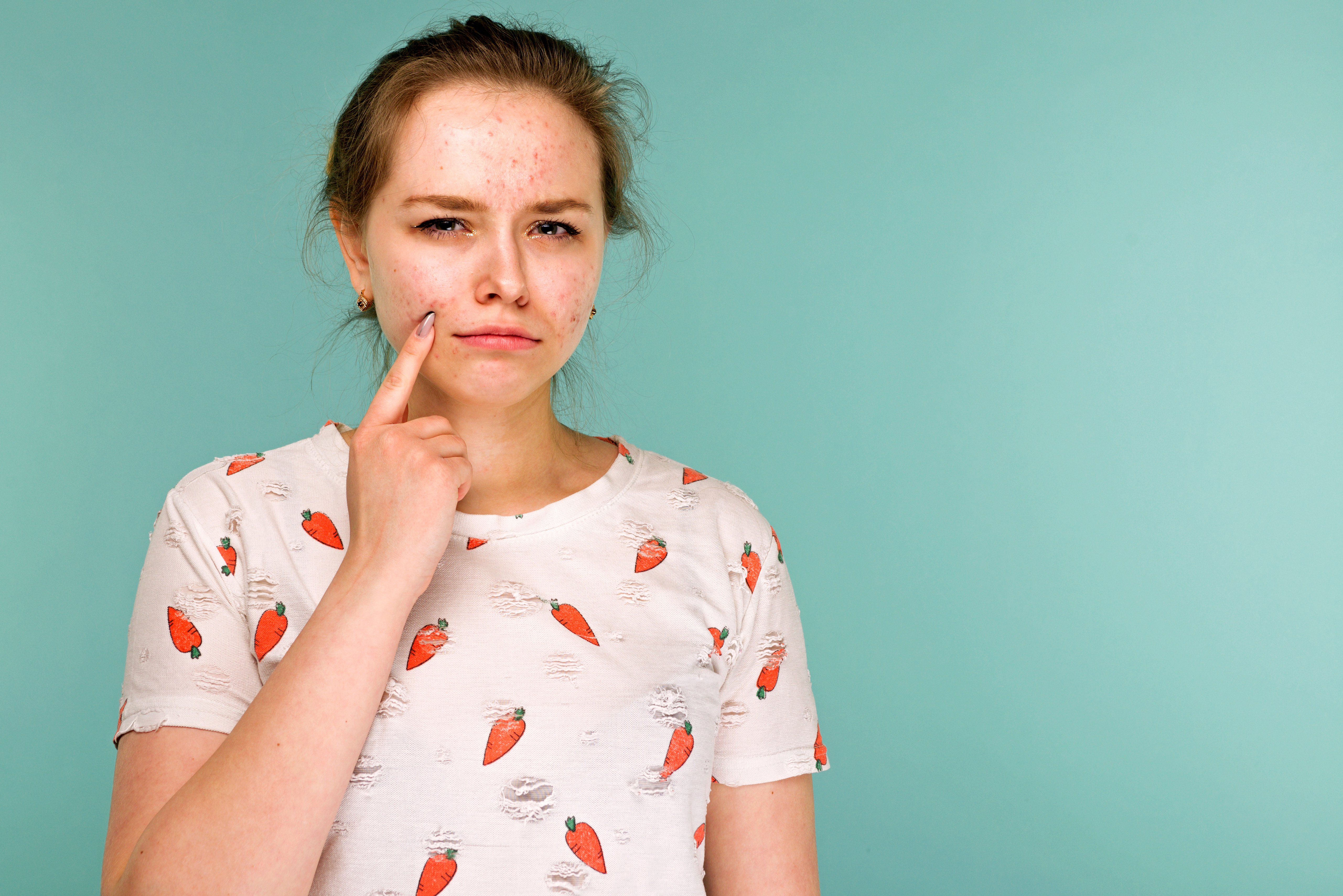Isotretinoin 10mg rezeptfrei