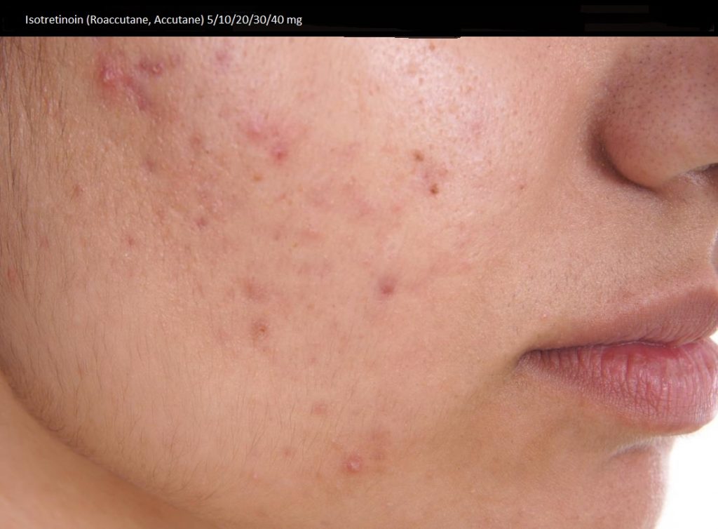 Isotretinoin kaufen