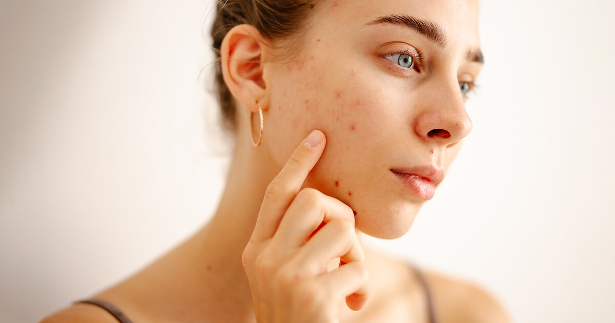 Isotretinoin Gel Ohne Rezept