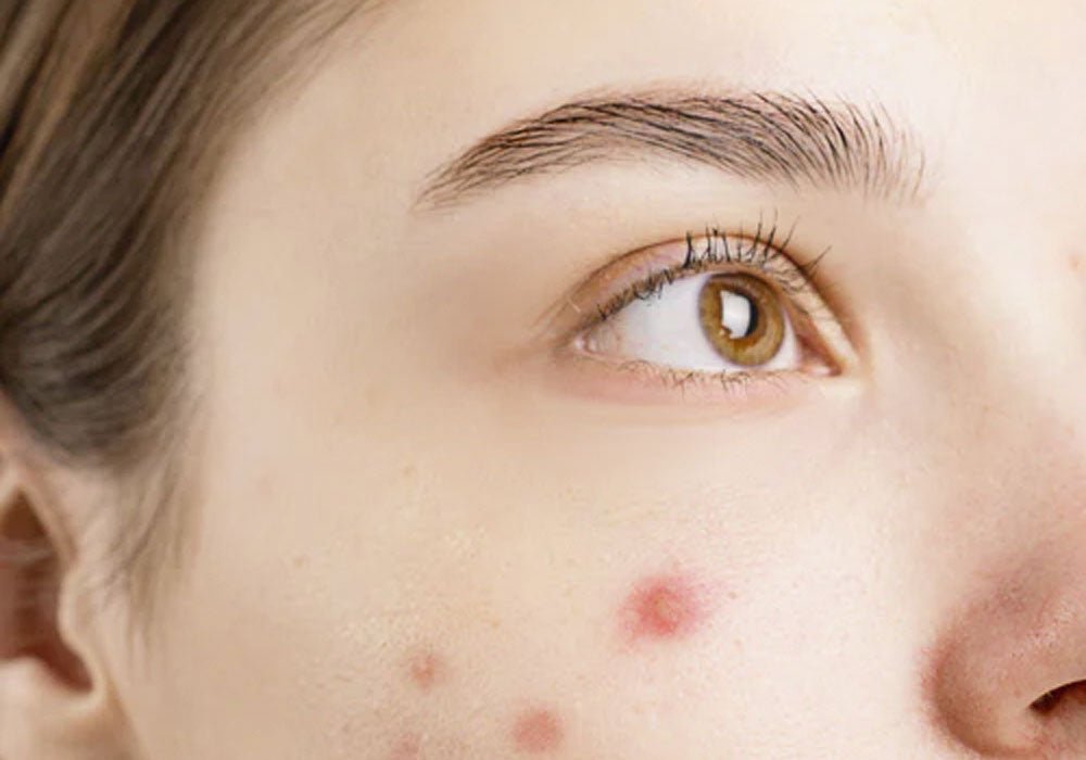 isotretinoin nach absetzen der pille